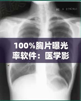 100%胸片曝光率软件：医学影像诊断的神器